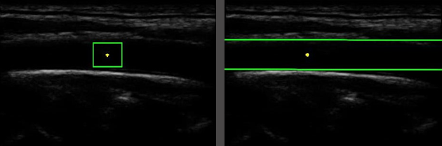 Featured image from Automatic Segmentation of Common Carotid Artery in Longitudinal Mode Ultrasound Images Using Active Oblongs.